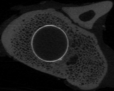CT-Bild vor automatischer Auswertung (Graustufe): gut erkennbar ist der durch die Beschichtung verstärkte Kontrast der Implantatkontur (Institut für Biomechanik, ETH Zürich, Zürich)